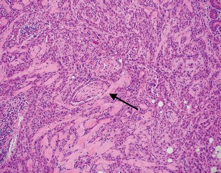 Squamoid Eccrine Ductal Carcinoma Mdedge Dermatology