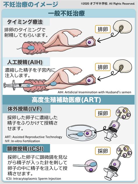 イラストで理解する排卵誘発と採卵 ゼロから理解する不妊治療4│見えてくる産婦人科学 オブギネ学校