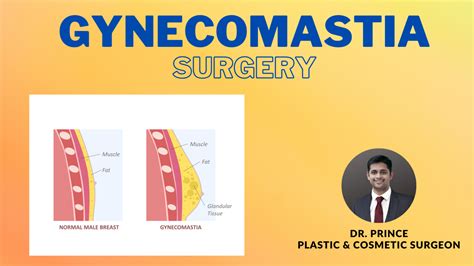 Restoring Confidence A Comprehensive Guide To Gynecomastia Surgery By