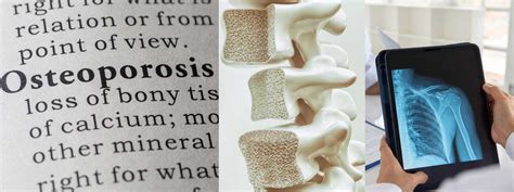 Osteoporosis Fracture Sites