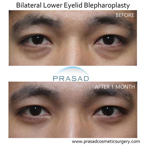 Effective Treatment Options For Bags Under The Eyes Dr Prasad Blog