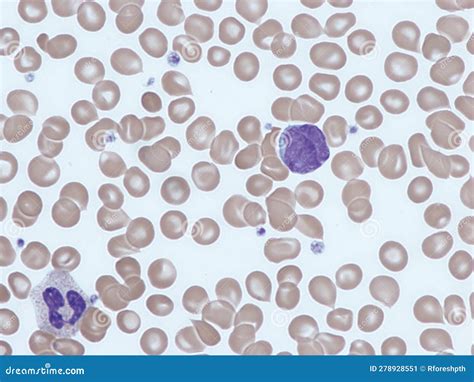 Sezary cell. stock illustration. Illustration of lymphocyte - 278928551