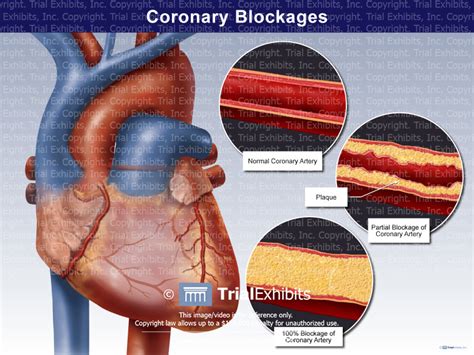 Coronary Blockages Trial Exhibits Inc