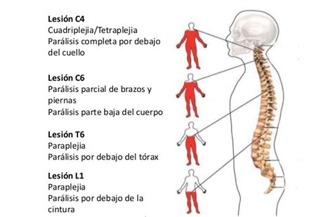 Paraplejia Asociaci N Espa Ola De Bancos De C Lulas Madre