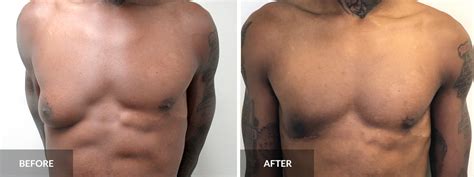 Gynaecomastia Surgery Near Me Liberty Decker