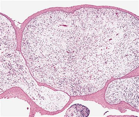 Pathology Outlines Embryonal Rhabdomyosarcoma