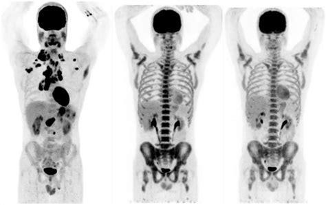 Maximum Intensity Projection Mip Of Positron Emission Tomography