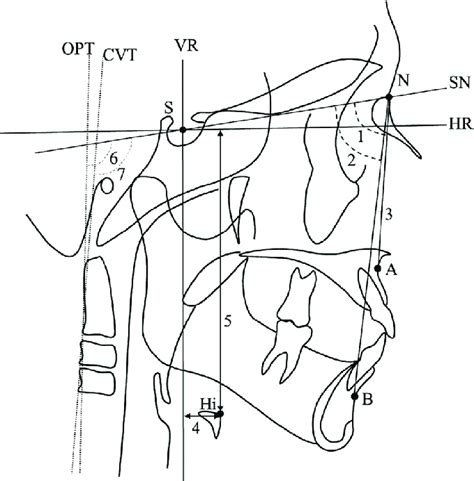 Linear And Angular Measurements 1 Sna 2 Snb 3 Anb 4 Hi Vr 5 Download Scientific