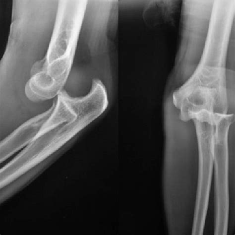 Anterior-posterior and lateral radiographs of the elbow before reduction | Download Scientific ...