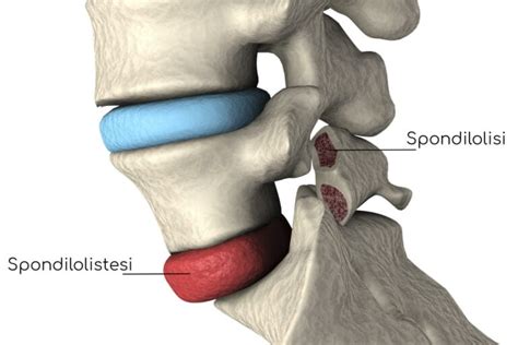 Spondilolistesi Cause Sintomi Pericoli E Cura Valori Normali