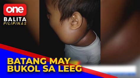 10 Anyos Na Lalaki May Iniindang Bukol Sa Leeg Youtube