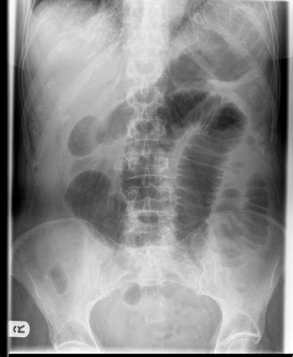 Small Bowel Imaging Flashcards Quizlet