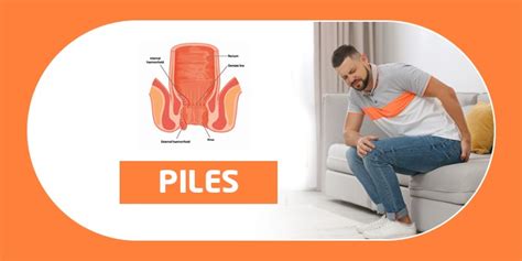 PILES- ITS TYPES, SYMPTOMS, AND CAUSES – Getron Wellness