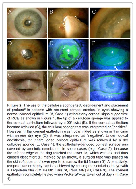 Self Retained Amniotic Membrane For Recurrent Corneal Erosion