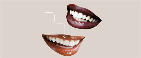 Exploring The Different Types Of Dental Veneer Procedures Available In