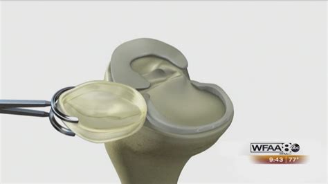 Nusurface Meniscus Implant Clinical Trial At Arlington Orthopedic