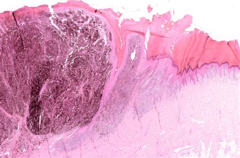 Acral Lentiginous Melanoma With A Nodular Like Vertical Growth Phase