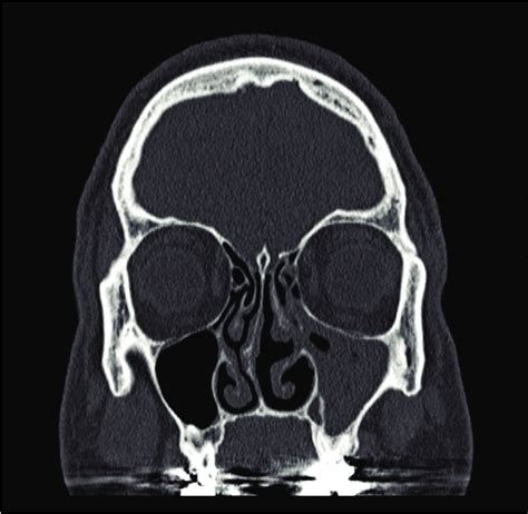 Ct Scan Of Sinuses Chronic Sinusitis