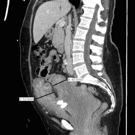 Ct Scan Abdomen Pelvis With Contrast Showing Large Retroperitoneal Mass