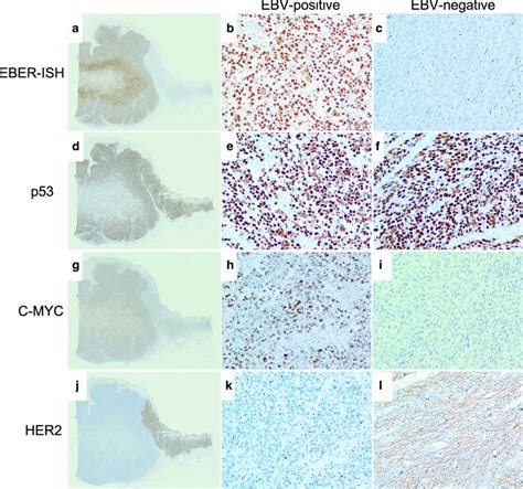 Findings Of Ebv Encoded Small Rna Eber In Situ Hybridization Ish Download Scientific