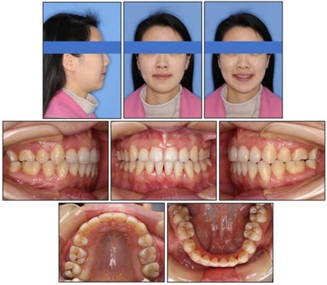 Medicina Free Full Text Vertical Control Of A Severe Hyperdivergent Skeletal Class Ii