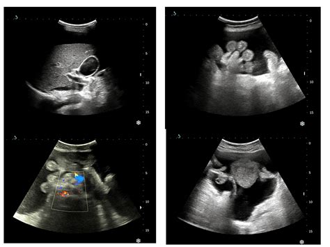 VIETNAMESE MEDIC ULTRASOUND: CASE 376: UREMIC ASCITES, Dr PHAN THANH ...