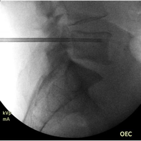 Intra Operative Fluoroscopy Of Bone And Disc Biopsy Download Scientific Diagram