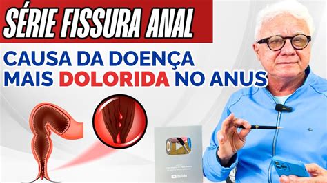 Série físsura anal Causa da doença mais dolorida no anus YouTube