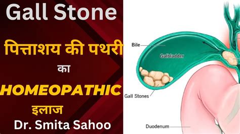 Gall bladder stone पततशय क पथर Homeopathic treatment for gall