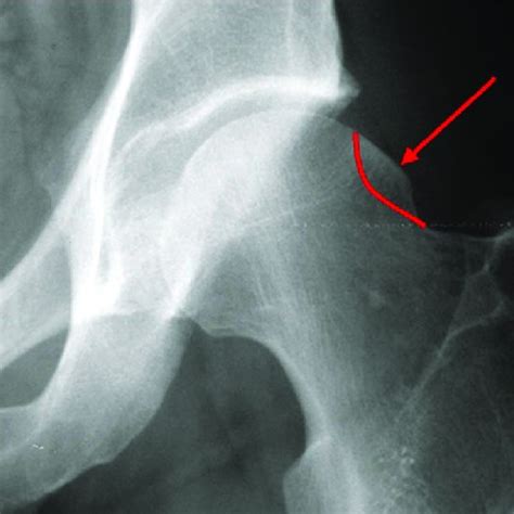 Anterior Acetabular Labral Tear Seen On Mri Arthrogram Ct Scan 3d