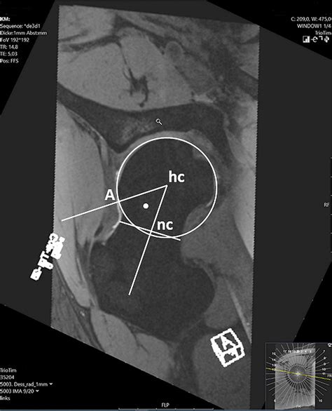 Manual Alpha Angle Measurement Hc Center Of The Femoral Head