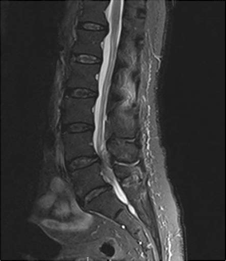 When will your doctor recommend a MRI/ CT Scan for evaluation of back ...