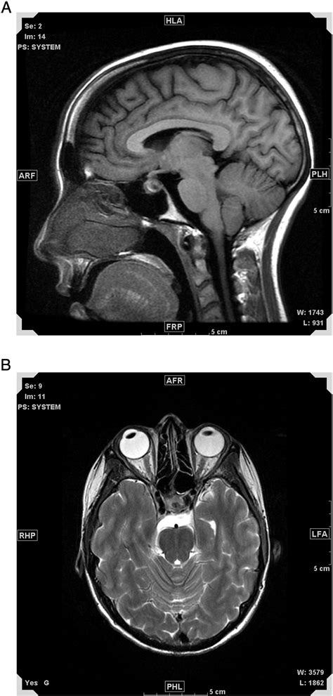 Rare Presentation Of Ewing Sarcoma Metastasis To The Sella And