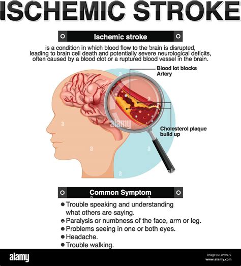 Informative Poster Of Ischemic Stroke Illustration Stock Vector Image