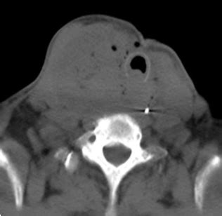 Anaplastic thyroid cancer CT - wikidoc