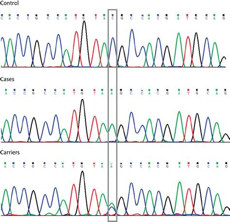 Sequence traces from exon 2 of the TPO gene showing the mutation Y55X ... 