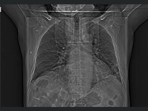 The chest X-ray in the posteroanterior view shows viral pneumonia ...