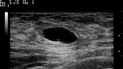 Subcutaneous Dermoid Cyst Ultrasound