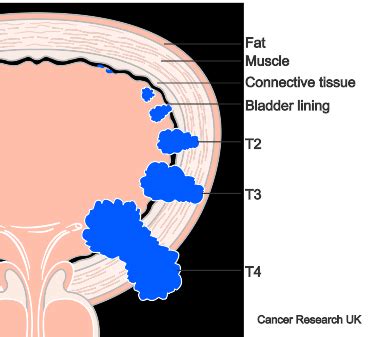 Muscle Invasive Bladder Cancer Staging Cancer Research Uk