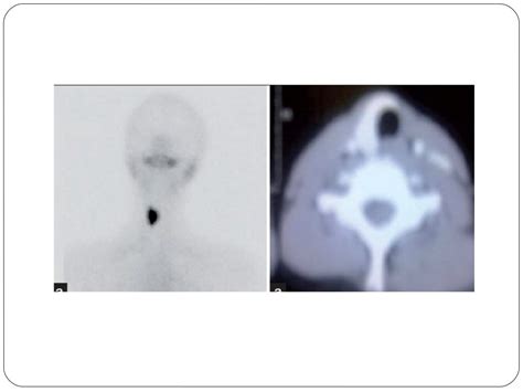 Radionuclide Imaging Thyroid And Parathyroid