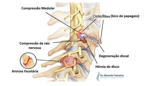 Artrodese Cervical Quando Ela Necess Ria