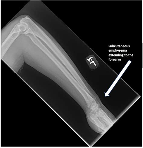 High Pressure Injection Injury To The Hand A Case Report Jetem