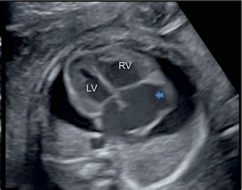 Fetal Pericardial Effusion Ultrasound