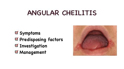 Angular Cheilitis Or Angular Stomatitis Youtube