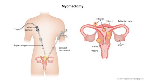 Laparoscopic Myomectomy Procedure