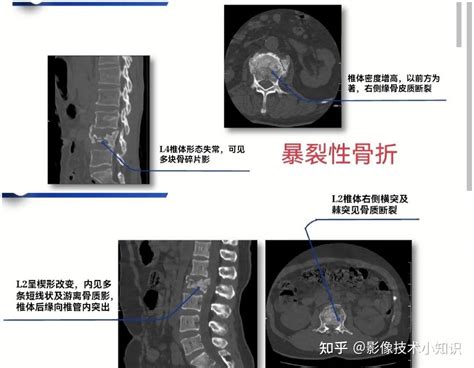 骨折影像表现（1） 知乎