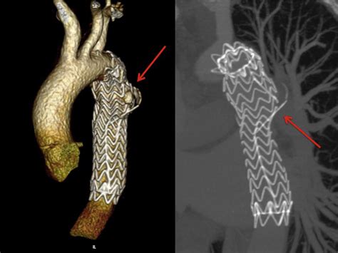 Type Iiib Endoleak 19 Years After Thoracic Endovascular Aneurysm Repair