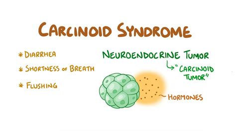 Carcinoid syndrome: Video, Anatomy & Definition | Osmosis