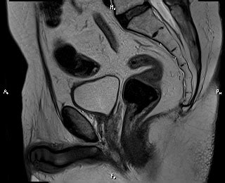 Inguinal Hernia Containing Urinary Bladder Image Radiopaedia Org