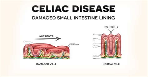 What Is Celiac Disease Causes Symptoms Diagnosis Treatment